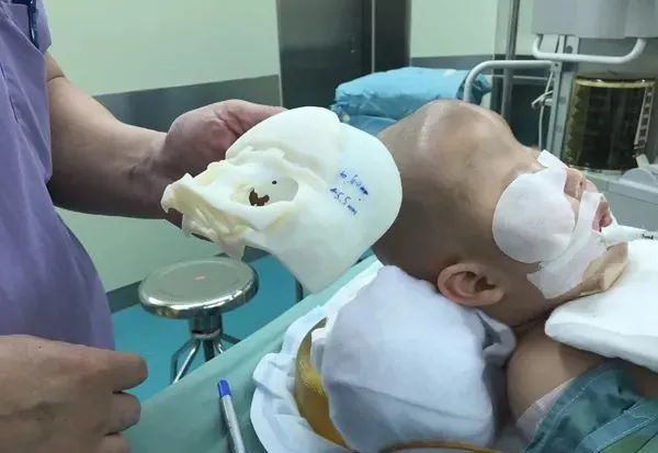 利用3D打印技术 医生成功给河南11个月大的婴儿重拼颅骨